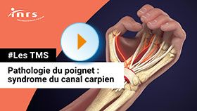 TMS - Pathologie du poignet - Syndrome du canal carpien