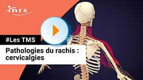 TMS - Cervicalgie